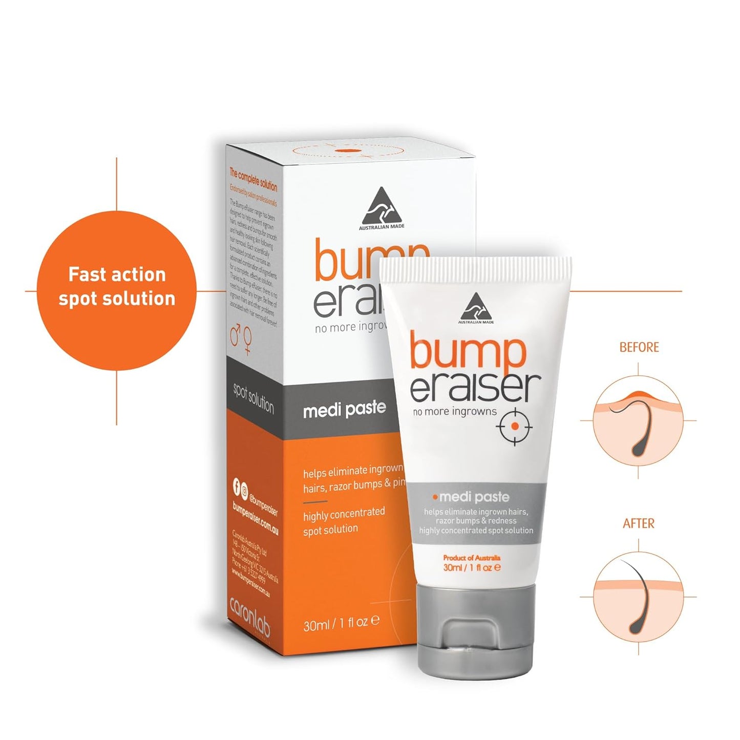 “Bump eRaiser Medi Paste 30 ml – Ingrown Hair & Razor Bump Treatment”