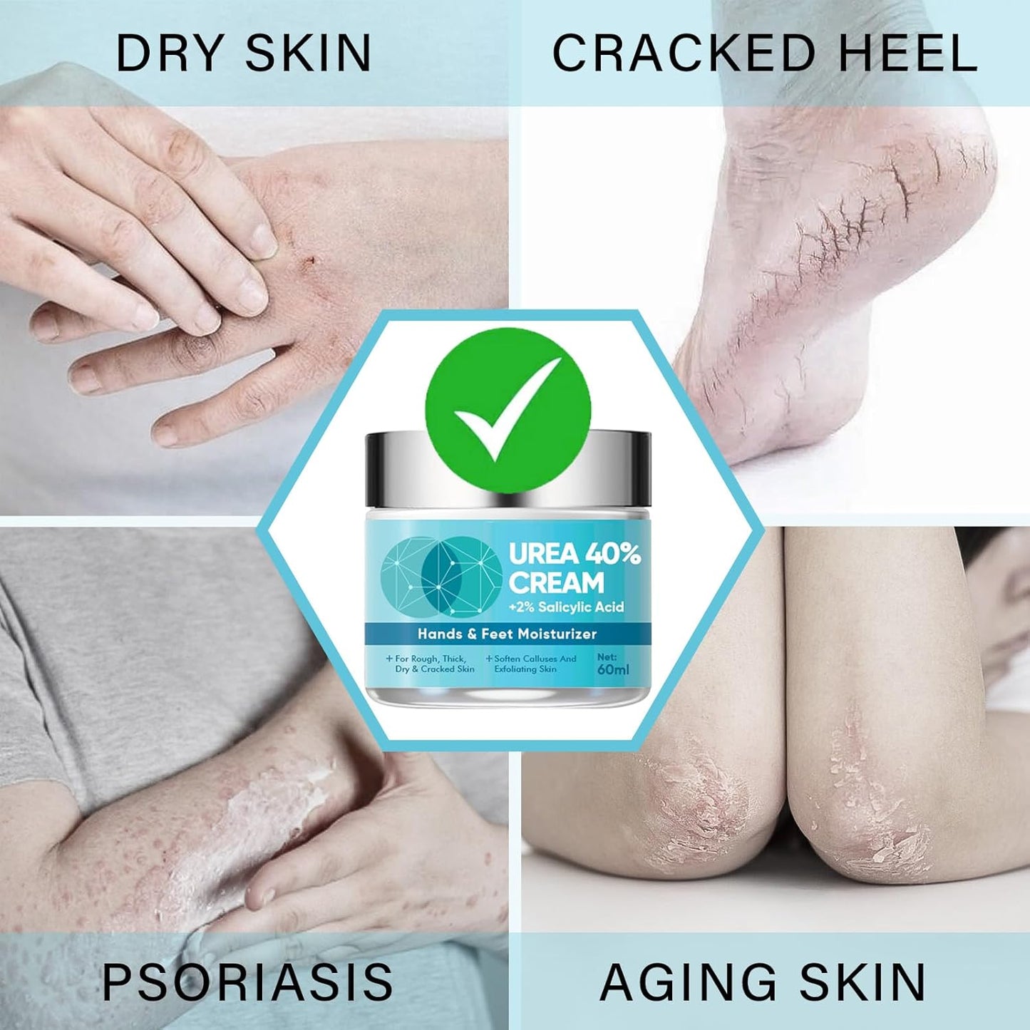 40% Urea Cream with Hyaluronic Acid & Aloe Vera – Deep Moisture for Dry Ski