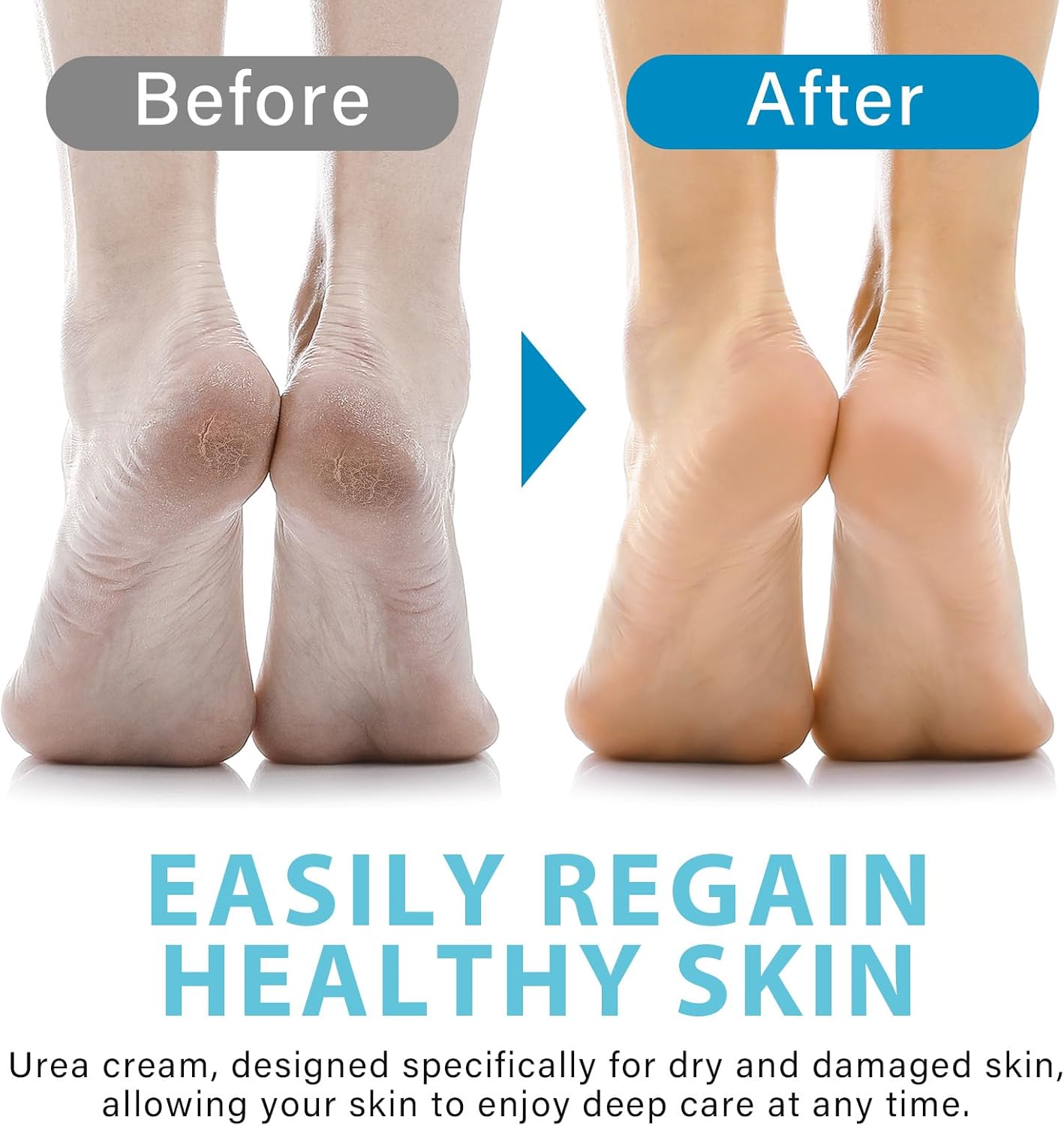 40% Urea Cream with Hyaluronic Acid & Aloe Vera – Deep Moisture for Dry Ski